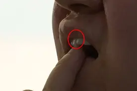 花8000元在美容院做美牙，结果吃东西成问题！院方：是我逼你做的？图片