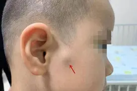 小孩脸上有个“包”，不是蚊子咬，警惕是这种疾病图片