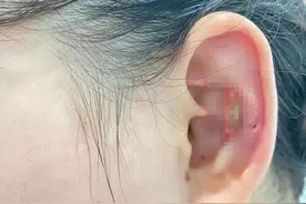 女子取耳软骨隆鼻致耳组织坏死，整形医院：先治疗，会恢复的图片