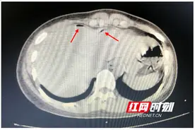 差点要命！长沙女大学生急性胃肠道穿孔，只因吃了一包隔夜辣条图片