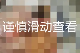 只是手指刮伤，怎么差点就要命了呢？图片
