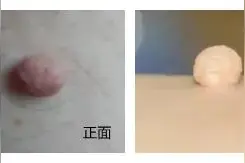 老年朋友注意了！身上长的“小肉粒”都是什么？千万别抠图片