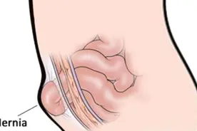 肚子出现肿块、鼓包？可能是腹股沟疝图片