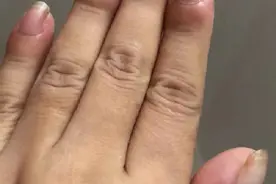 女子手指肿成“萝卜头”，一查竟是肺癌图片