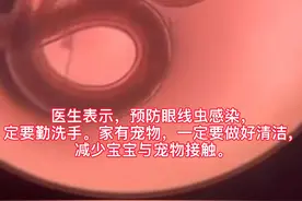 长沙10个月大男孩眼睛中取出虫子，或与宠物接触有关图片