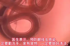 长沙10个月大男孩眼睛中取出虫子，或与宠物接触有关图片
