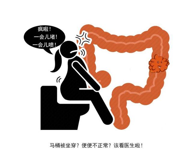 这5个症状或是肠癌的早期表现 提前重视起来