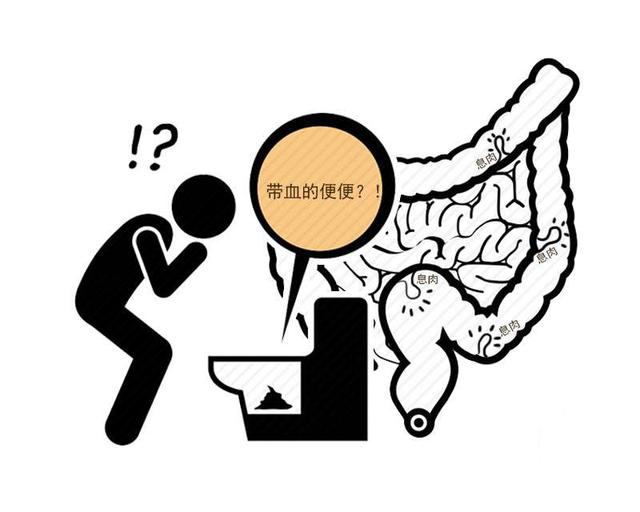 这5个症状或是肠癌的早期表现 提前重视起来