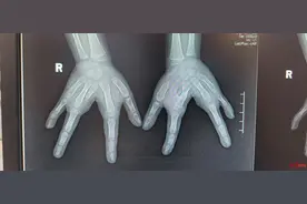 发病率十万分之一！4岁女孩天生“龙虾手”无法合拢 单只仅四根手指图片