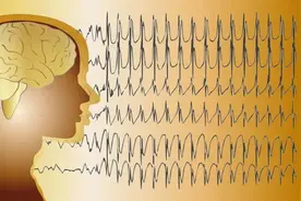 迷走神经刺激术，帮助孩子治愈了长达16年之久的癫痫病图片