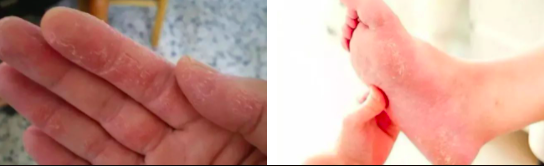 脚裂口子可以涂身体乳吗 脚裂口子可以涂身体乳吗