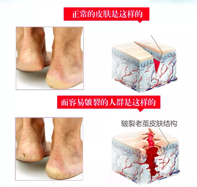 脚裂口子可以涂身体乳吗 脚裂口子可以涂身体乳吗