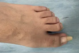 小伙双脚“甲包肉”行走困难，医生精细矫正抚平卷曲趾甲图片