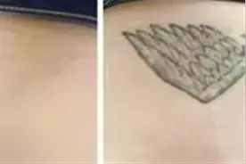 “纹时一时爽，清洗泪两行”男生冲动将手臂文成花臂，后悔想去除文身时才知图片