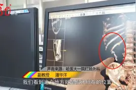 紧急！医生在他肠子里找了3个小时，终于找到它图片