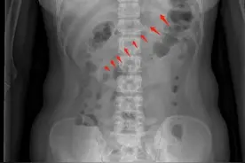女子吃麻辣烫后感觉咽喉有异物用勺子抠喉，竟把17厘米长勺子吞了下去图片