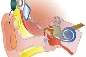 关于人工耳蜗植入，你了解多少？图片