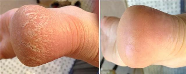 能不能用蛇油膏当身体乳