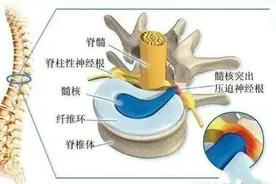 中医有办法丨腰椎间盘突出怎么办？综合治疗有良效图片
