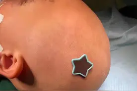 家中意外跌倒，3岁女童被“星星”磁力钉撞碎颅骨、刺破脑膜图片