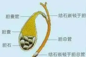 查出胆结石后，为什么一定要切除胆囊图片