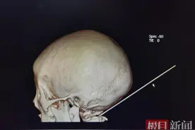 嫌娃学习太磨蹭，爸爸大发雷霆！8岁男孩躲闪时手中铅笔直插后脑勺图片