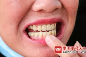 “做牙做到一半，直接磨短”！南宁一女子称做假牙被磨坏真牙，涉事诊所：没有问题图片