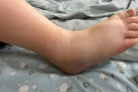 6岁男孩突然脚肿还发烧，竟是因大冬天被蚊子咬了一口图片