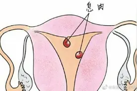 体检发现子宫息肉需要处理吗？图片