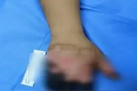 男子喝了一顿酒，4根手指没了图片
