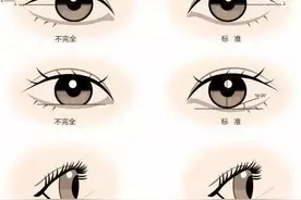 济南海峡整形科普：双眼皮做完后会消失吗？图片