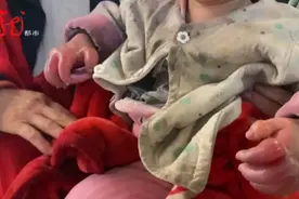 一岁半女童的这双手，太让人心疼了！爱是治疗“良方”，为她点燃生命希望……图片