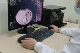 清洁除锈剂当水喝，男子自行催吐灼伤食管，专家：误服后不宜盲目催吐图片