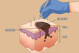 手术祛除和激光点痣如何选择？关于点痣，详细解答来了图片