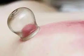 拔火罐到底吸出来是湿气，还是毒素？答案或和你想的不同图片