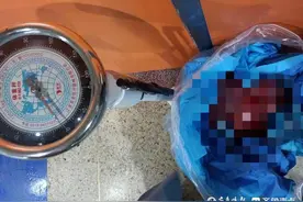 罕见！烟台一女子带“孕肚”生活三年，子宫肌瘤取出后减重50斤图片
