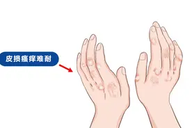 2022正式发布！银屑病/白癜风官方公益！最新申报详情来了图片
