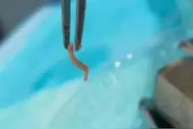 小伙牙疼去拔牙，揪出1厘米长活虫…图片