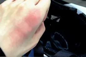 BY2妹Yumi再进医院！左手「一片红肿」伤势照曝：尽心尽力就不会有遗憾图片