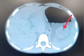 四岁女童空腹连吃6块柿饼吃到吐血，复旦儿科专家综合诊治转危为安图片