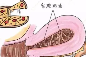 【妇产科普】别拿人流不当回事，小心宫腔粘连！图片