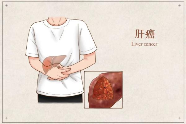 7种癌症易“遗传”！改变不健康生活方式可以预防癌症的发生