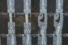 兰大二院骨科成功应用微波消融联合椎体成形技术治疗脊柱转移瘤图片