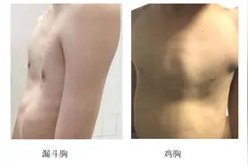 家长注意！小孩“鸡胸”或影响心肺！图片