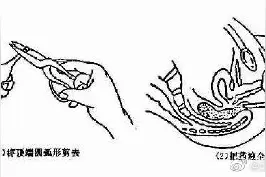 用开塞露通便不能常用图片