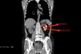 不痛的结石更可怕，女子患结石十余年毁掉一个肾图片