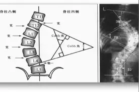 教学病例 | 脊柱侧凸矫形术的患者麻醉图片
