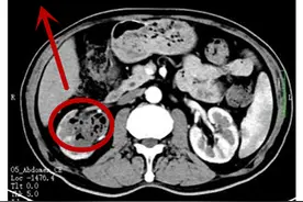 6旬“老糖友”小便拉出果冻样颗粒 竟是它在作祟图片