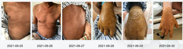 全身鸡皮肤该如何治