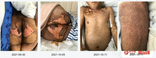 全身鸡皮肤该如何治